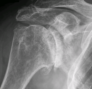 ShoulderOsteoarthritis
